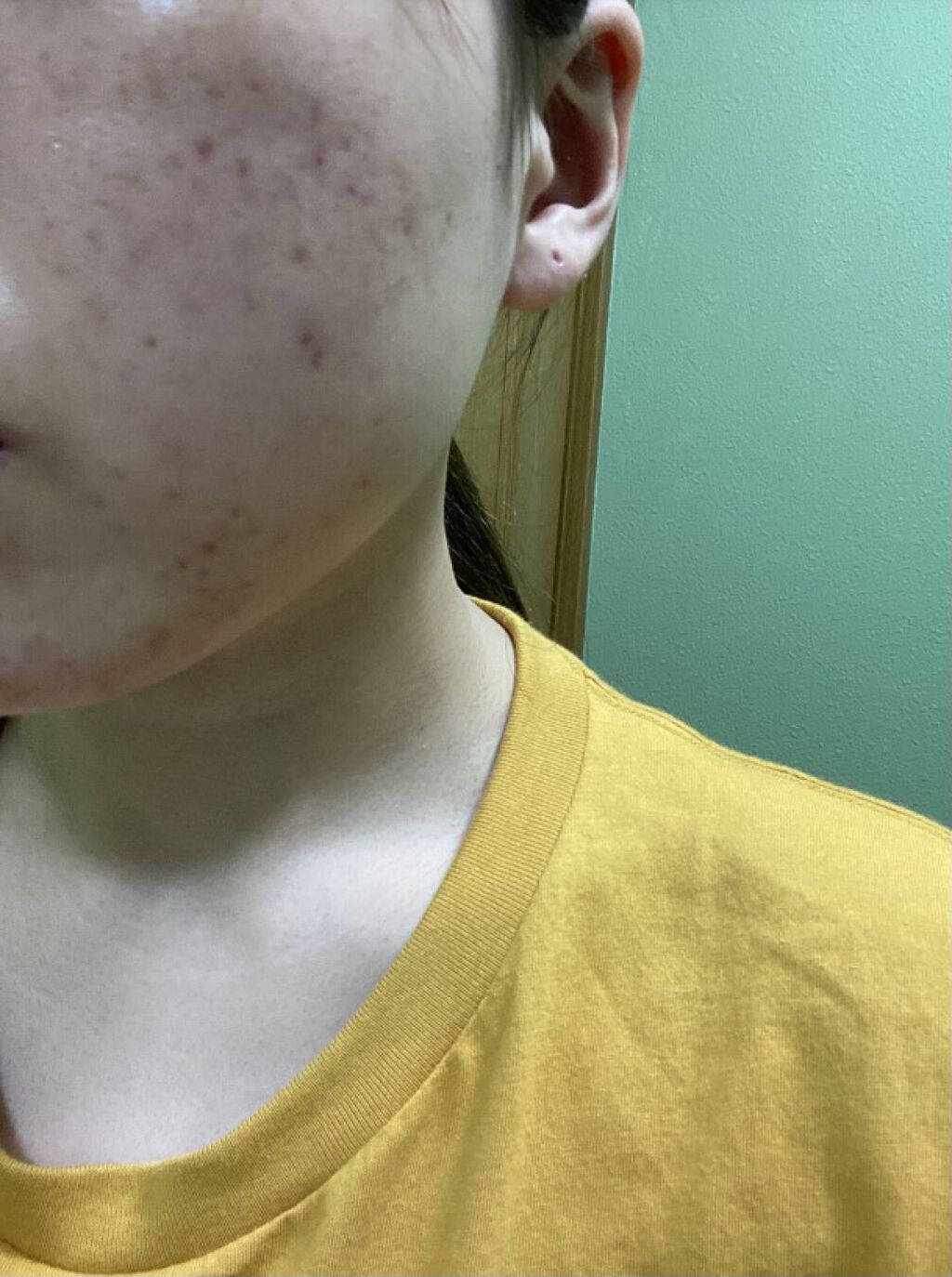 ロゼット洗顔パスタ アクネクリア/ロゼット/洗顔フォームを使ったクチコミ（3枚目）