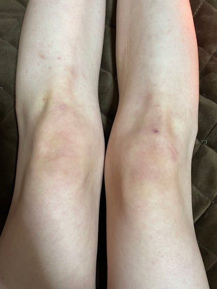 たこまる on LIPS 「経過報告!2枚目3枚目が使う前4枚目5枚目が今日です。使う前の..」(3枚目)