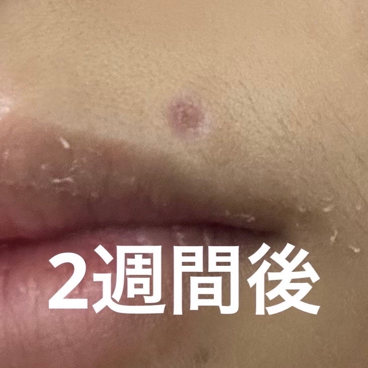 猫派 on LIPS 「ほくろ除去しました!!忘れないうちにメモします。私のほくろは膨..」(5枚目)