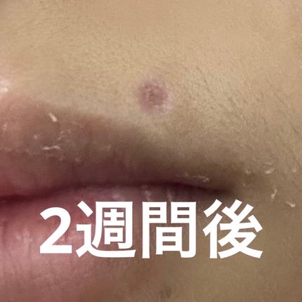 猫派 on LIPS 「ほくろ除去しました!!忘れないうちにメモします。私のほくろは膨..」(5枚目)