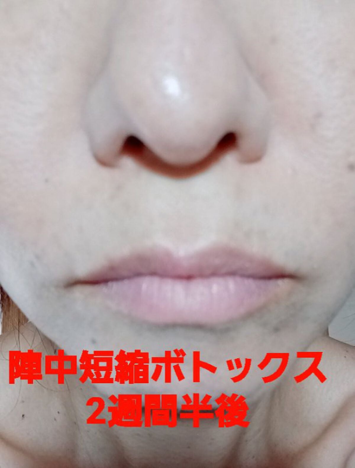 MJえむじぇー() on LIPS 「品川美容外科では渋谷院限定メニューだそうです。普段いつも上野院..」(3枚目)
