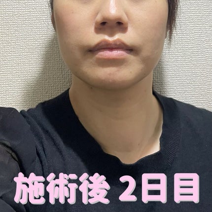 Tomomi on LIPS 「はじめての美容医療〜脂肪溶解リニアHIFU〜1回目施術後2日目..」(3枚目)