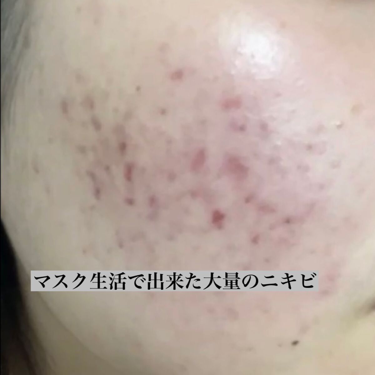 ふうか on LIPS 「#ニキビ_ニキビ跡#ベースメイク#&_be#コスメデコルテ#イ..」(3枚目)