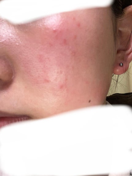 薬用顔ローション/ヘパソフト/化粧水を使ったクチコミ(3枚目)