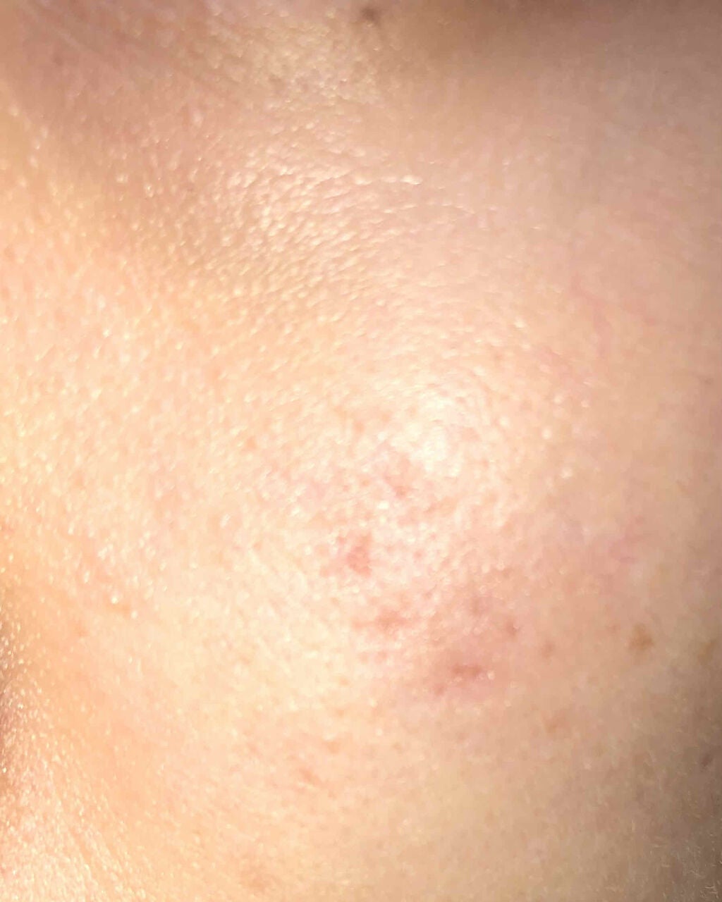 supreme_perfume_iqq on LIPS 「ニキビについて教えてください!ニキビ跡、ニキビが消えません、、..」(3枚目)