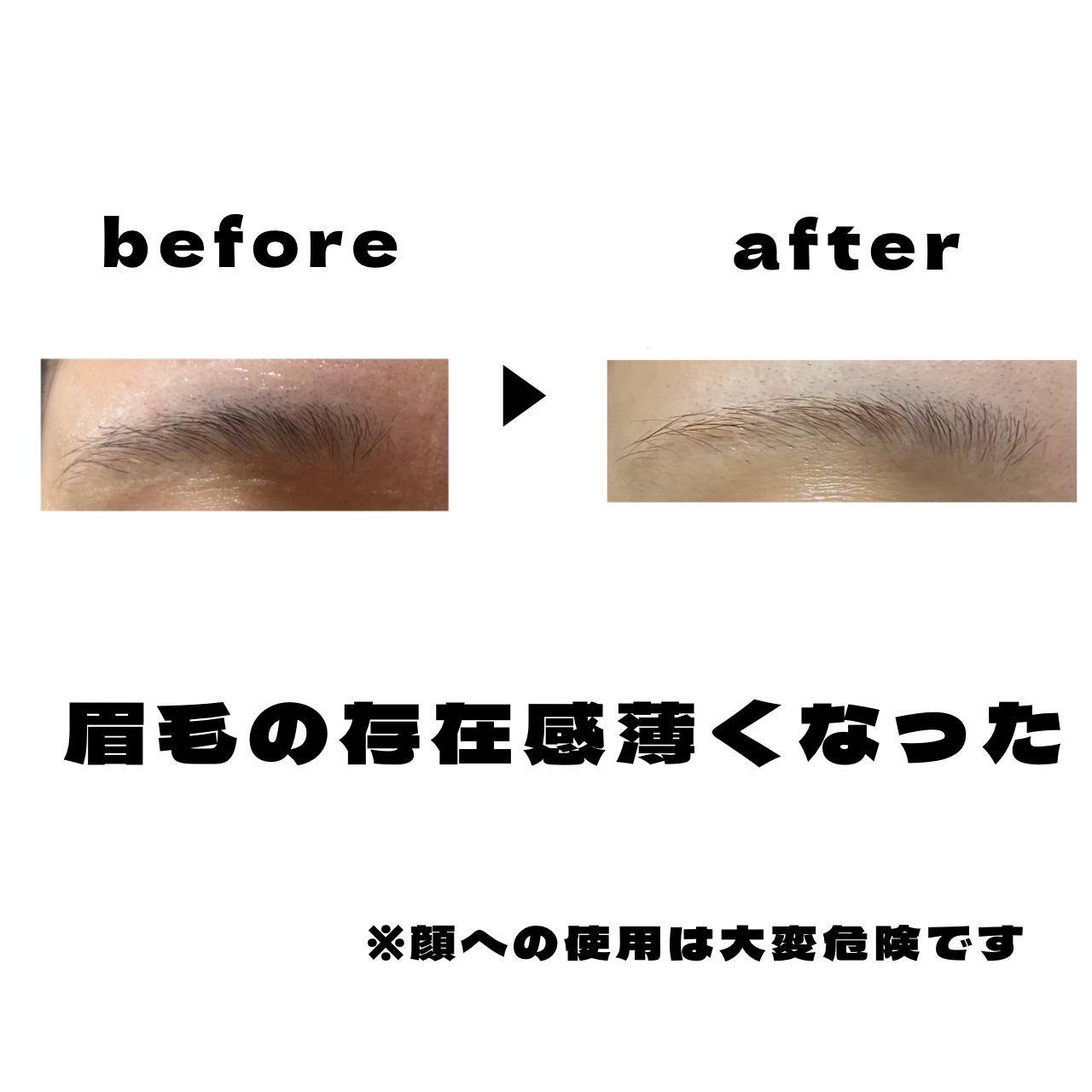 脱色クリーム 敏感肌用/エピラット/ムダ毛ケアを使ったクチコミ（2枚目）