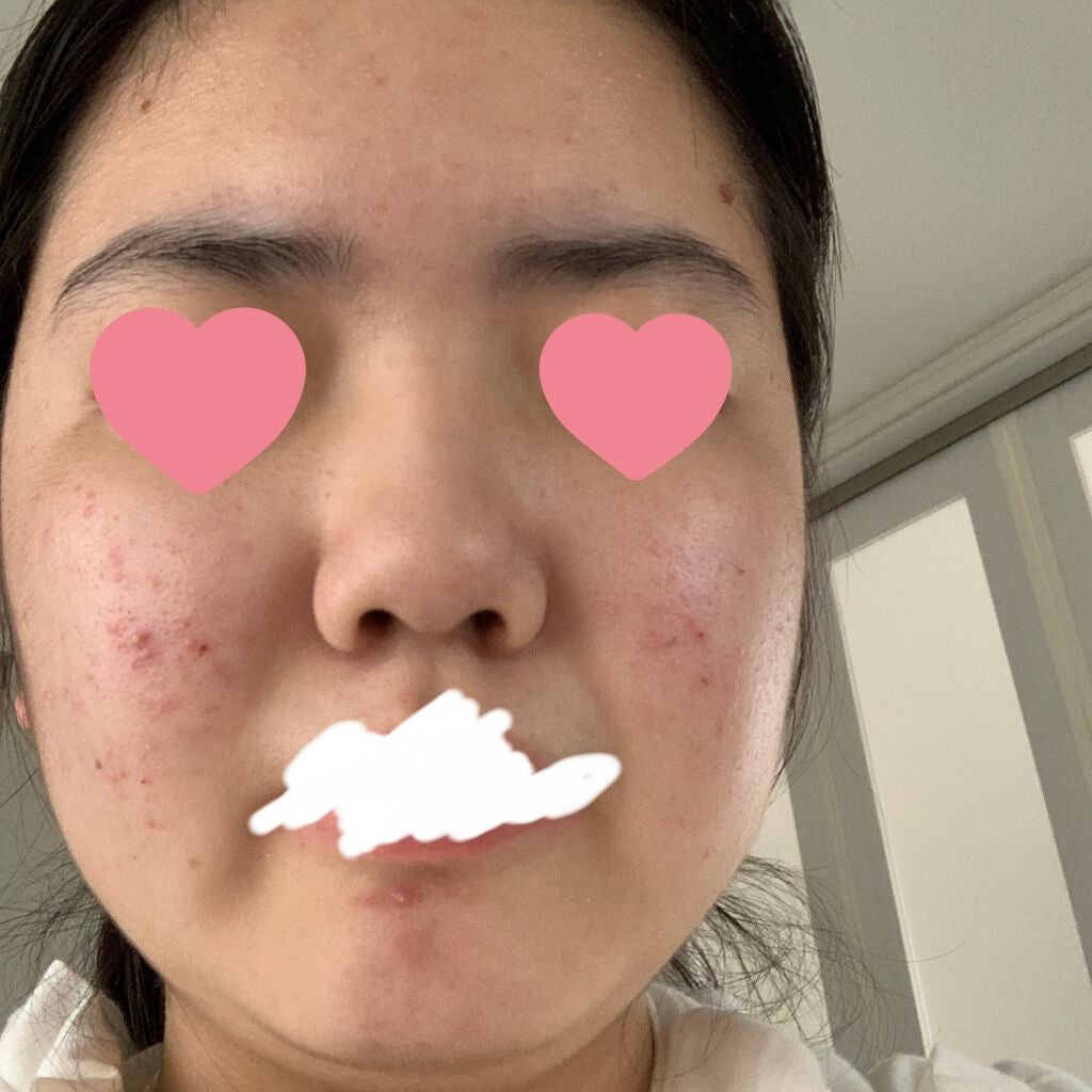 ノブ A アクネソープ/NOV/洗顔石鹸を使ったクチコミ(4枚目)