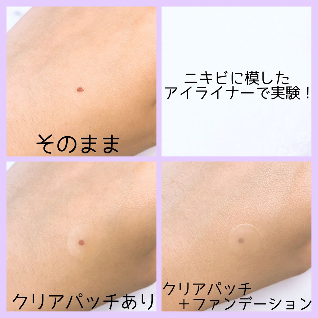 クリアパッチ/Angelab/にきびパッチを使ったクチコミ（2枚目）