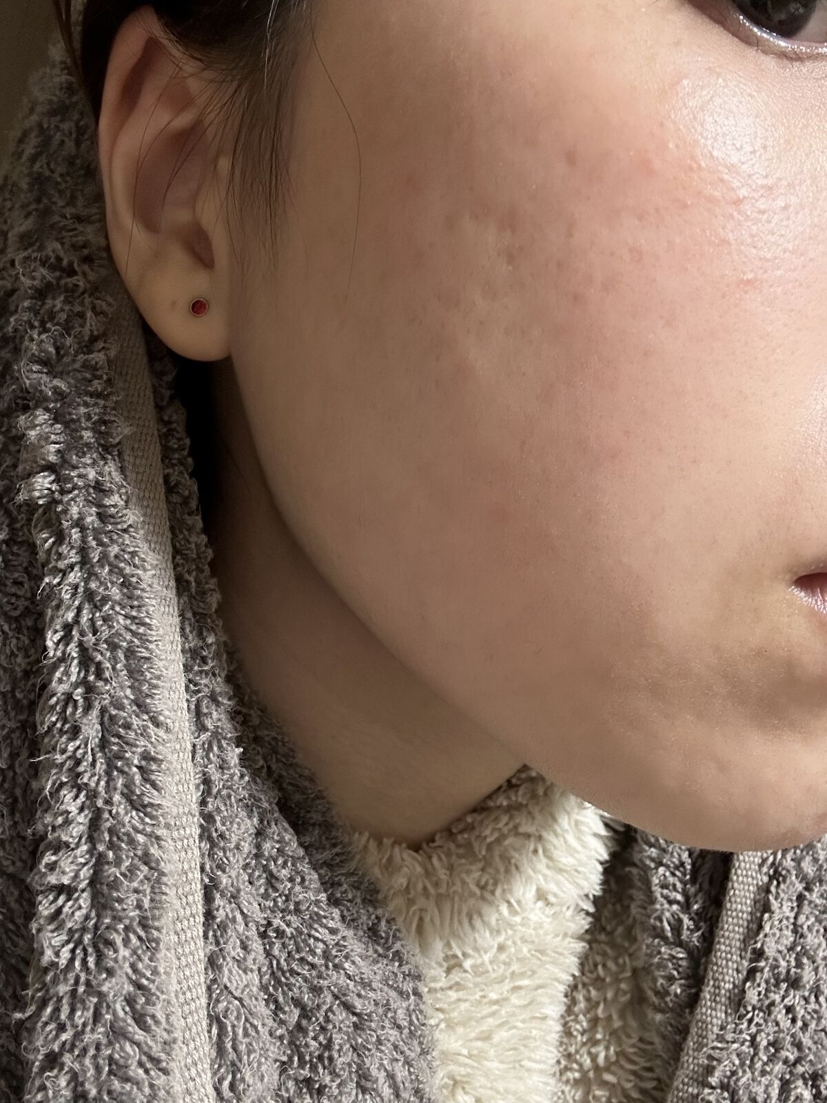 ティーツリーバイオーム ブレミッシュシカアンプル/MEDIHEAL/美容液を使ったクチコミ（2枚目）