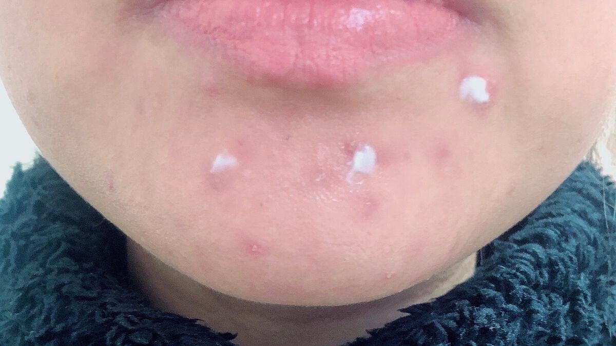 アクネス25(医薬品)/メンソレータム/その他を使ったクチコミ(2枚目)