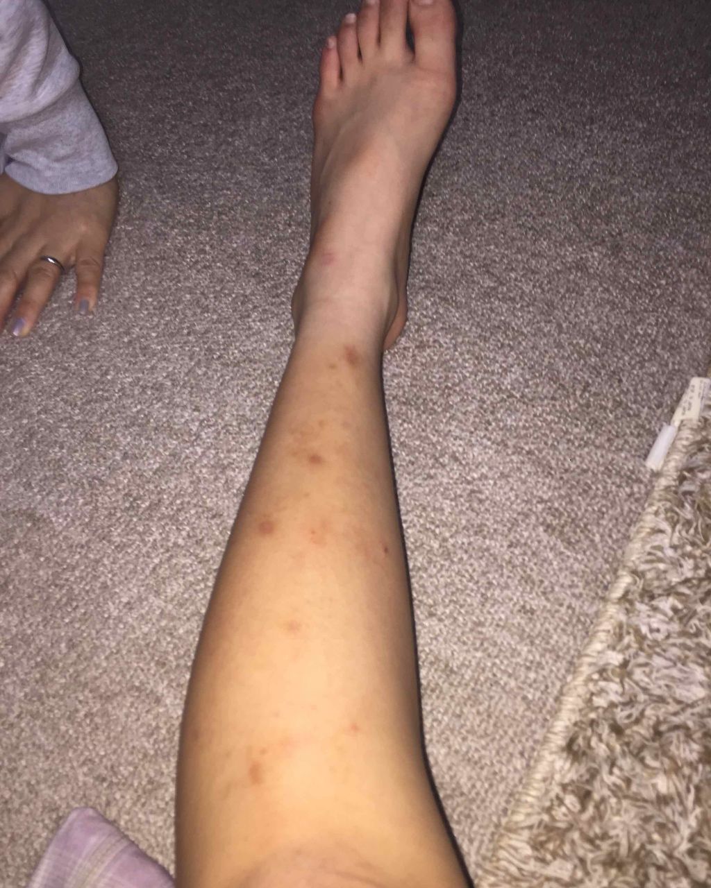 あすか on LIPS 「こんにちはー皆さんに相談です💦わたしは小さい頃から足に傷跡?み..」(2枚目)