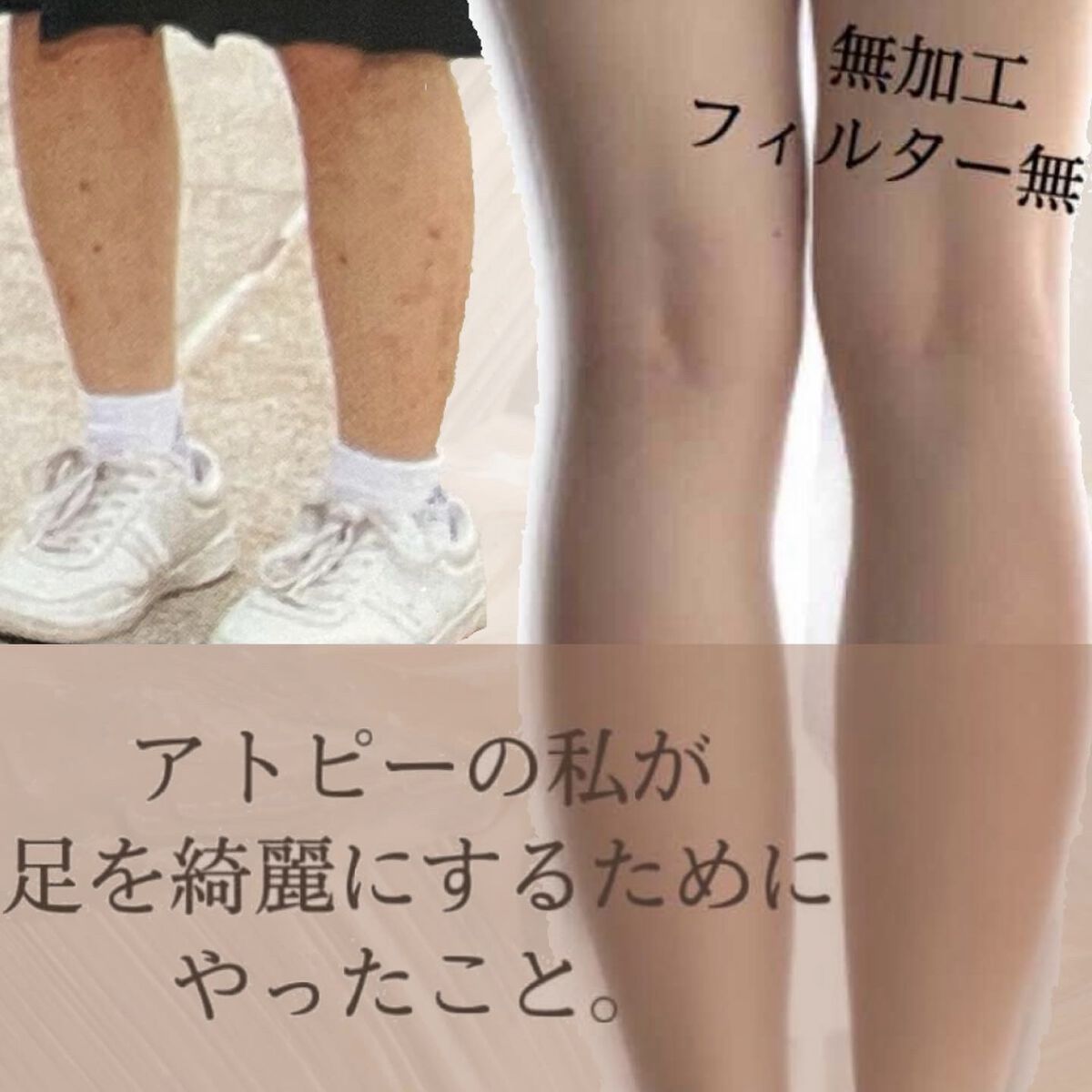 紹介した商品じゃなくても
今使っているものでぜひ試してみてください🐰



今回は
｢新たな傷を増やさない為の方法｣でしたが、
｢今ある傷跡を治すためにやった事｣もあるので
また紹介します！



正直効果が現れるのには時間がかかります
