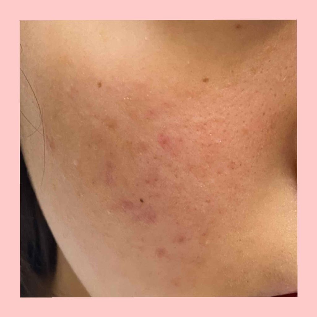 薬用 しみ 集中対策 美容液/メラノCC/美容液を使ったクチコミ（3枚目）