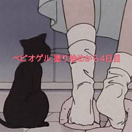 ベピオゲル/マルホ株式会社/その他を使ったクチコミ(1枚目)