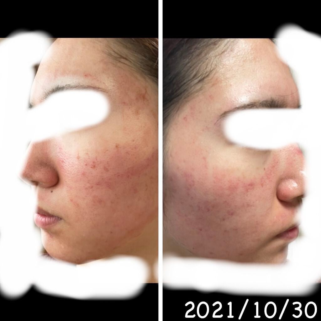 Honk❁ on LIPS 「20歳前半の女がニキビに悩まされすぎてダーマペン受けてみた。こ..」(3枚目)