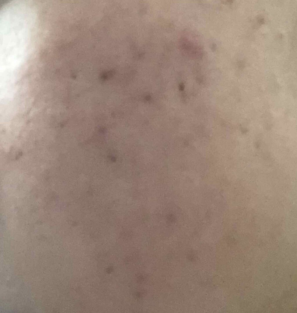 あさひ on LIPS 「5日目とつにゅーいやー、昨日悪化してからどうなったかドキドキし..」(2枚目)