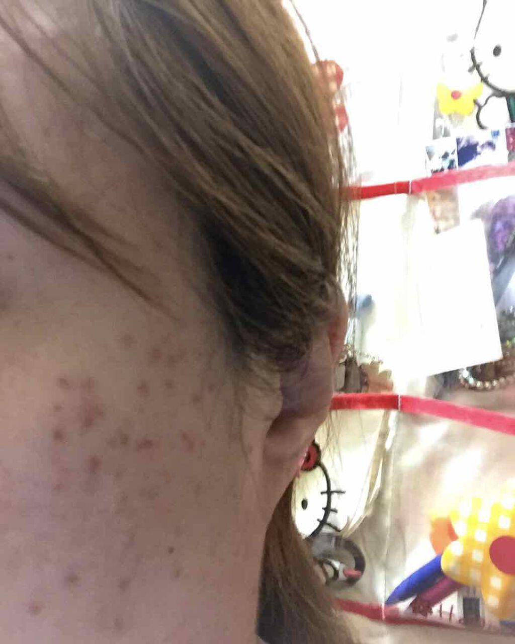 リサ・ラーソン♡クッションファンデマニア on LIPS 「突然の、汚肌💧画像🙇♂️ごめんねm(__)m以前は、大人ニキ..」(3枚目)