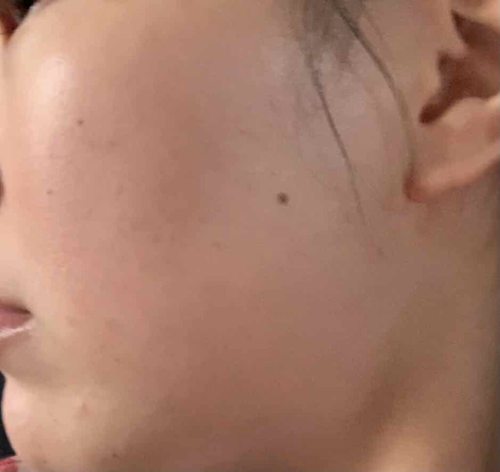 ピアソンＨＰクリーム(医薬品)/ピアソンHP/その他を使ったクチコミ（1枚目）