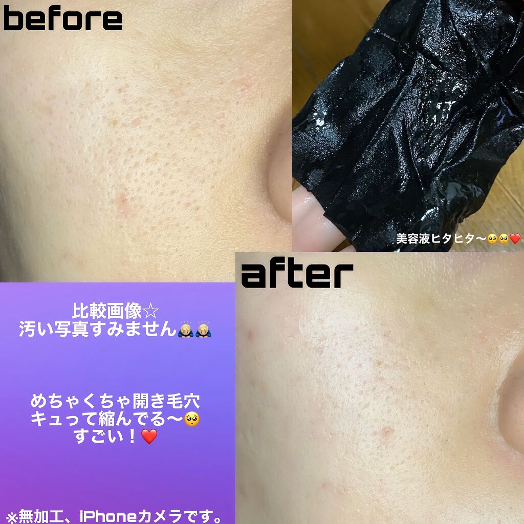 ピュアブラック アクアモイスチャー シートマスク/ALFACE+/シートマスク・パックを使ったクチコミ(2枚目)