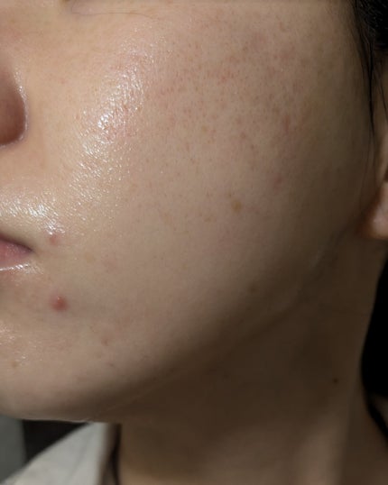 miina@汚肌工事録⚠️ on LIPS 「10/26の#汚肌工事録冬のあごニキビに効く方法あったら教えて..」(2枚目)