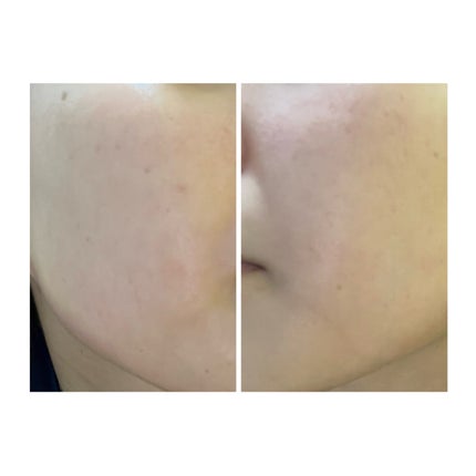 ぽむ on LIPS 「2023.9.13皮膚科に受診 エピデュオとヘパリン処方1枚目..」(4枚目)