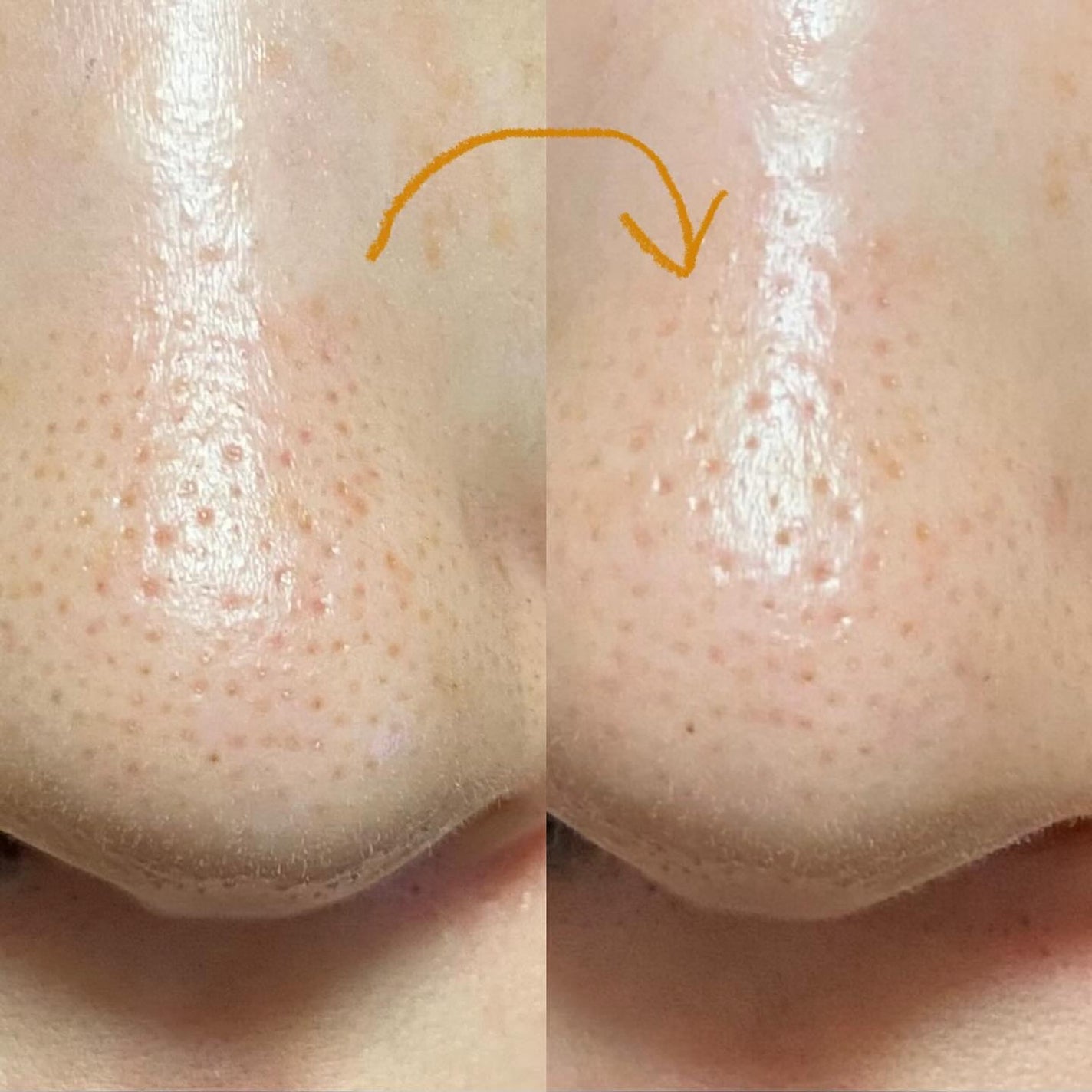 アンチポアブラックヘッドパーフェクトクリアキット/CNP Laboratory/シートマスク・パックを使ったクチコミ(5枚目)