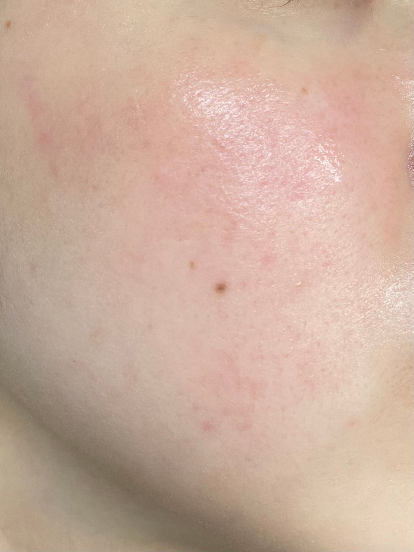 あかね on LIPS 「記録用(5/2)1週間前に皮膚科に行ってきました。ロゼックスゲ..」(3枚目)