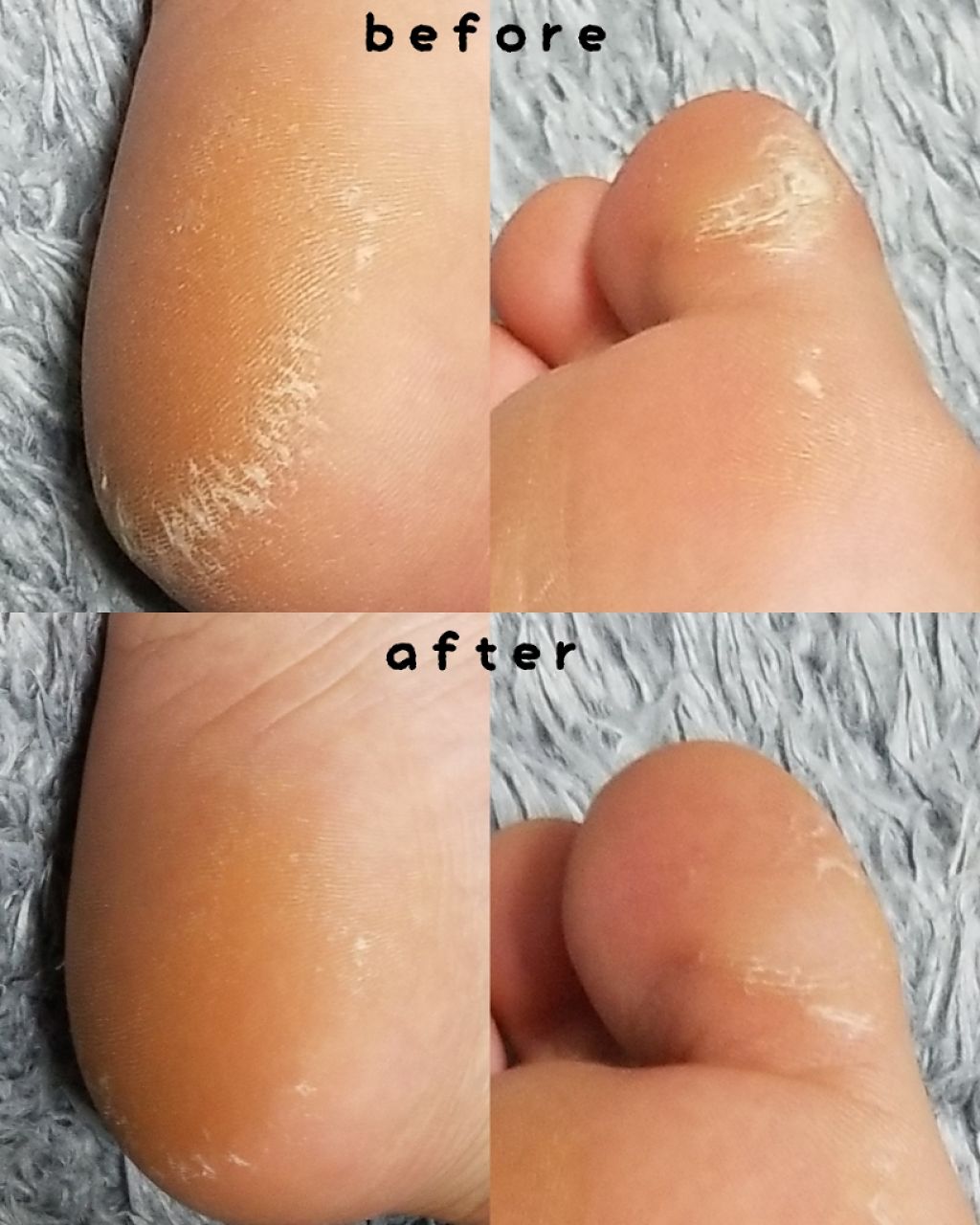 ベルベットスムーズ 電動角質リムーバー 海洋ミネラル/ドクター・ショール/レッグ・フットケアを使ったクチコミ(3枚目)