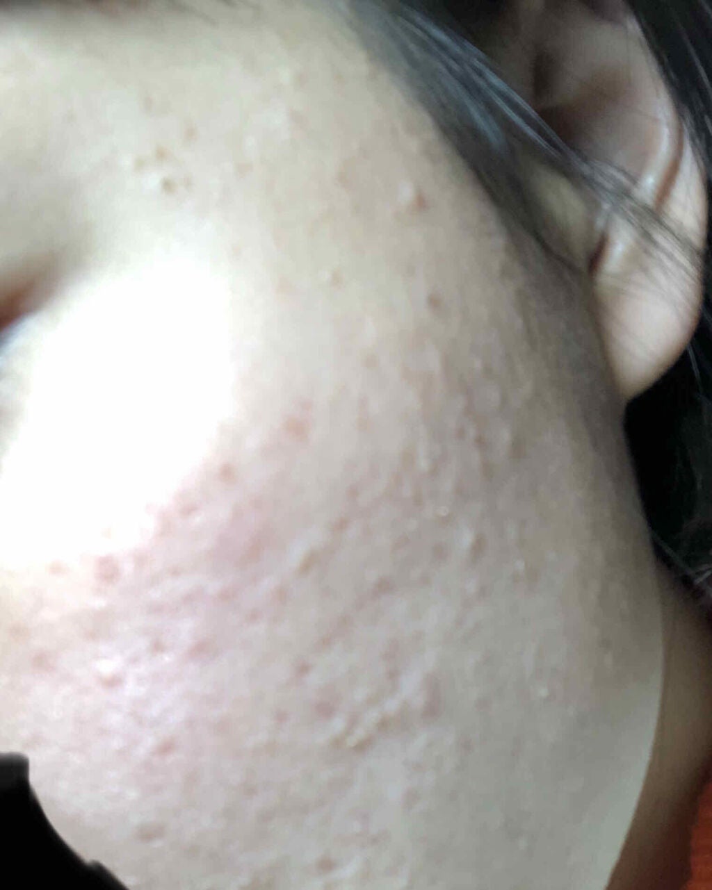 きらり。 on LIPS 「助けてください。⚠️閲覧注意⚠️#肌#ニキビニキビ跡..」(2枚目)