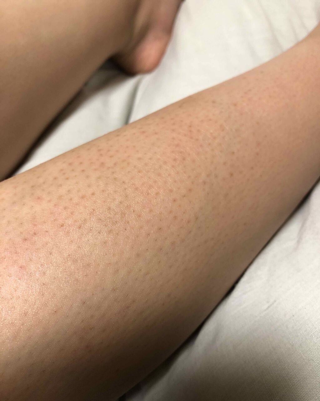 ケアノキュア(医薬品)/小林製薬/その他を使ったクチコミ(1枚目)