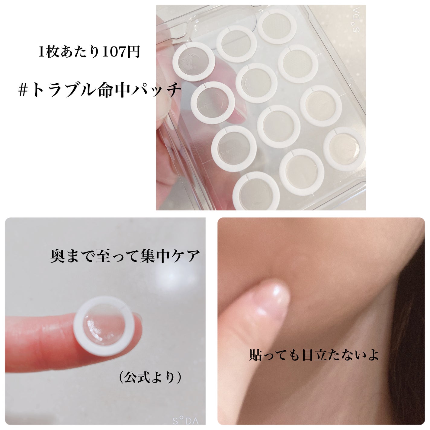 エーキュアショットスポットパッチ/obsero/にきびパッチを使ったクチコミ(4枚目)