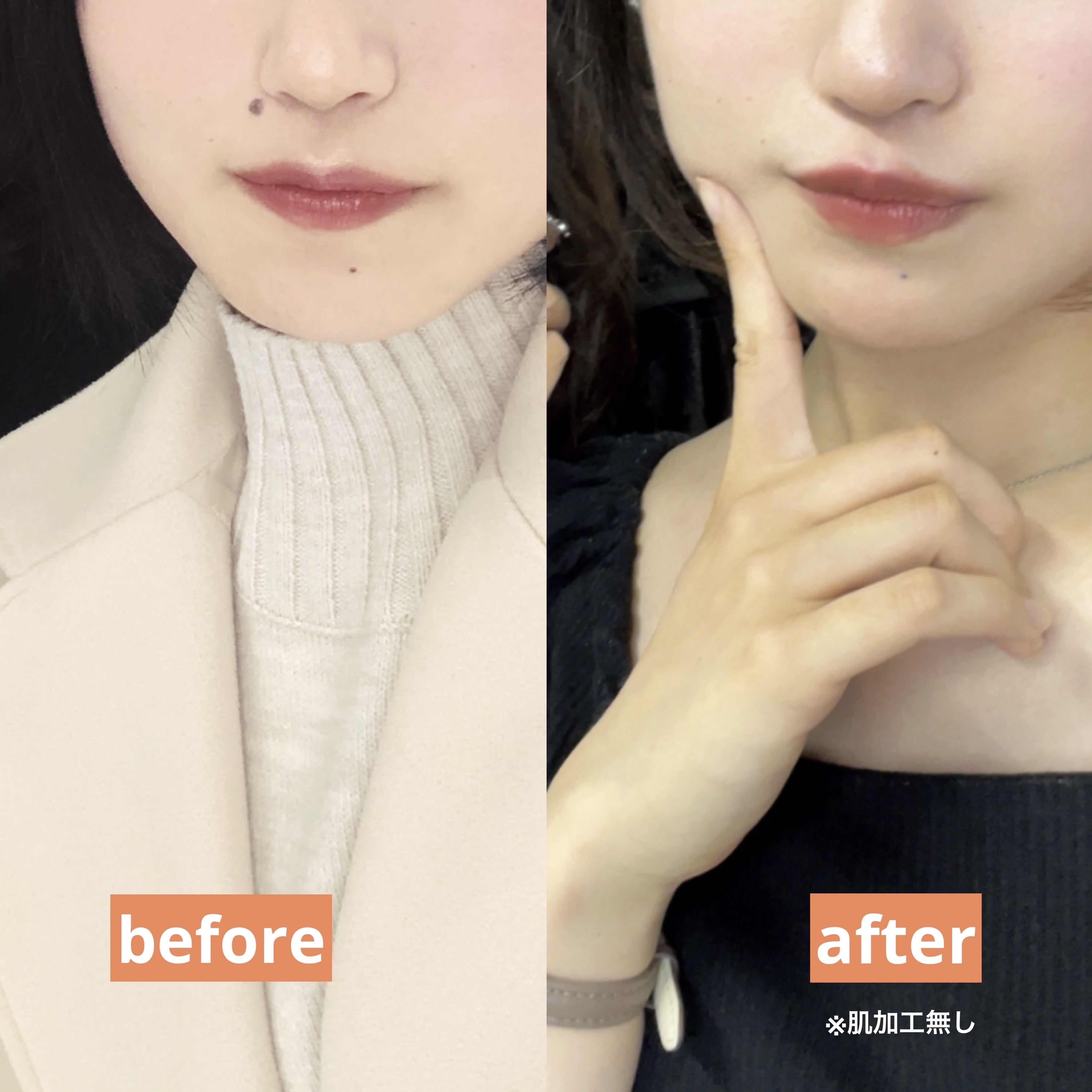 キズパワーパッド スポットタイプ/バンドエイド/その他を使ったクチコミ（2枚目）