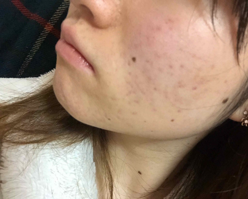 マンスリースキンケアプログラム(旧)/APEX/スキンケアキットを使ったクチコミ(4枚目)