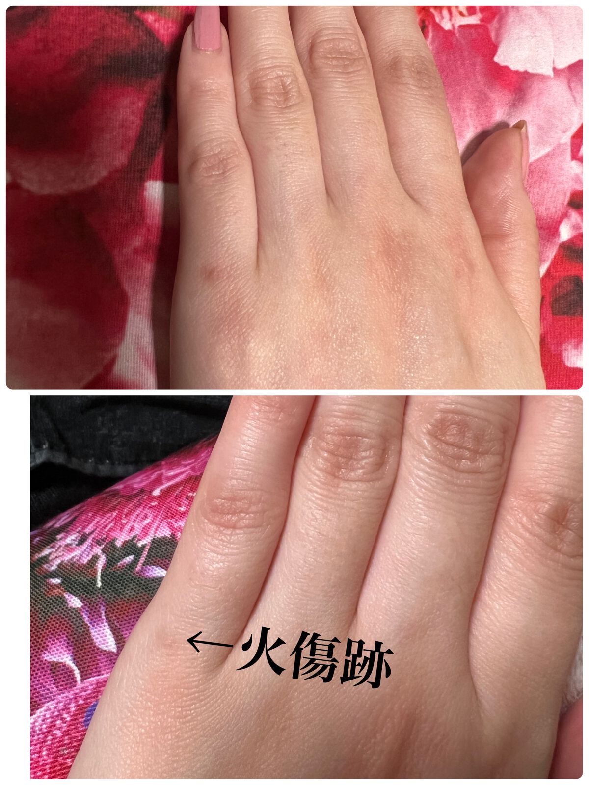 アットノンEX ジェル(医薬品)/アットノン/その他を使ったクチコミ(1枚目)