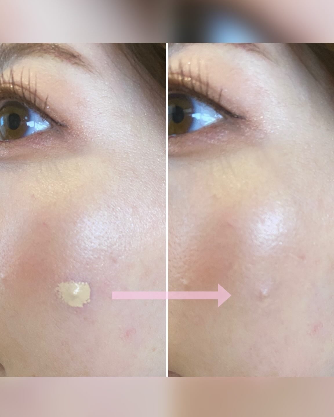 ダーマシンコンシーラー/23years old/リキッドコンシーラーを使ったクチコミ(6枚目)