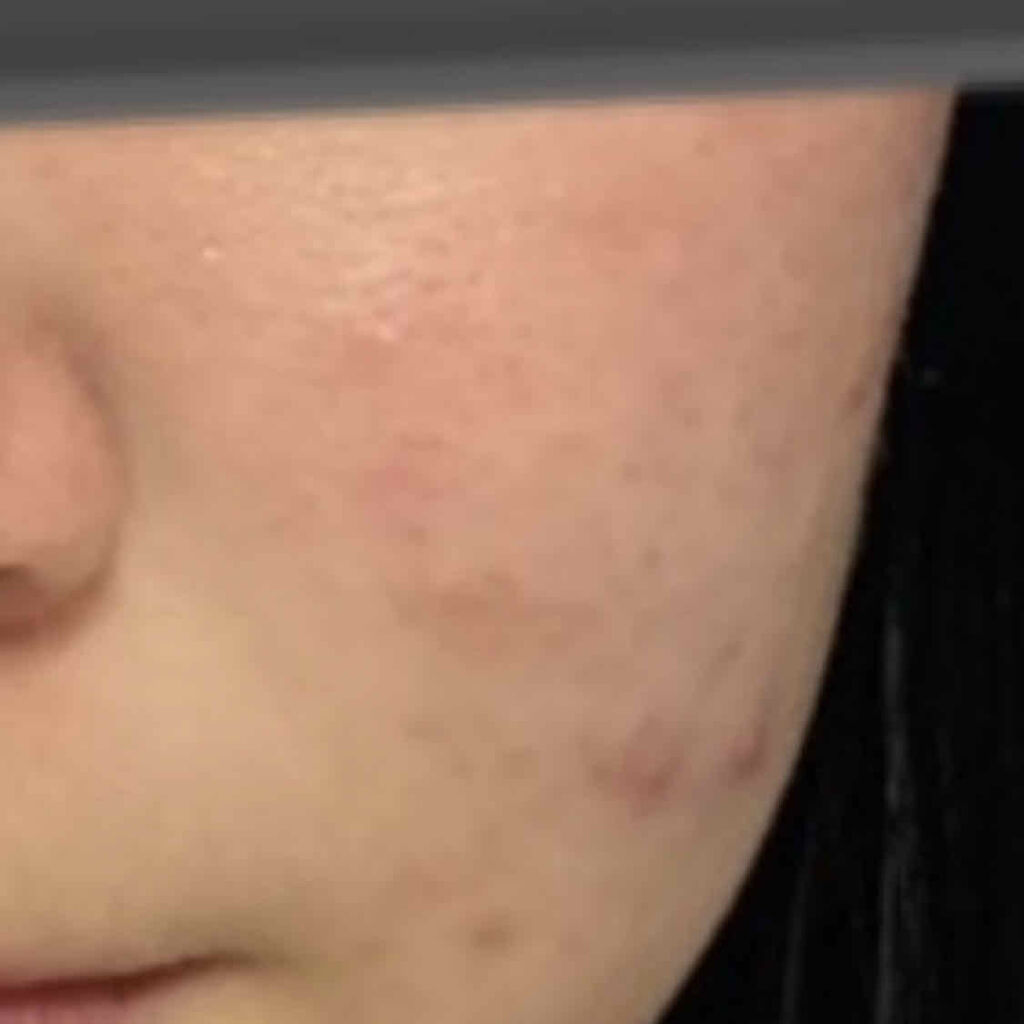 A アクネフォーム/NOV/洗顔フォームを使ったクチコミ（1枚目）