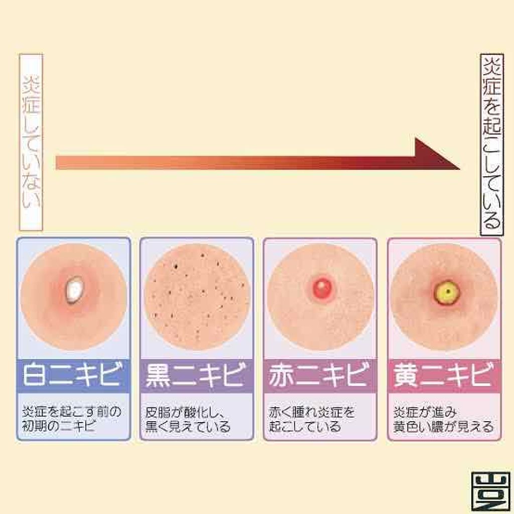 オロナインＨ軟膏 (医薬品)/オロナイン/その他を使ったクチコミ（2枚目）