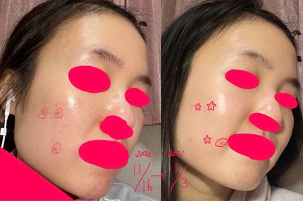 DHC はとむぎエキス/DHC/健康サプリメントを使ったクチコミ(5枚目)