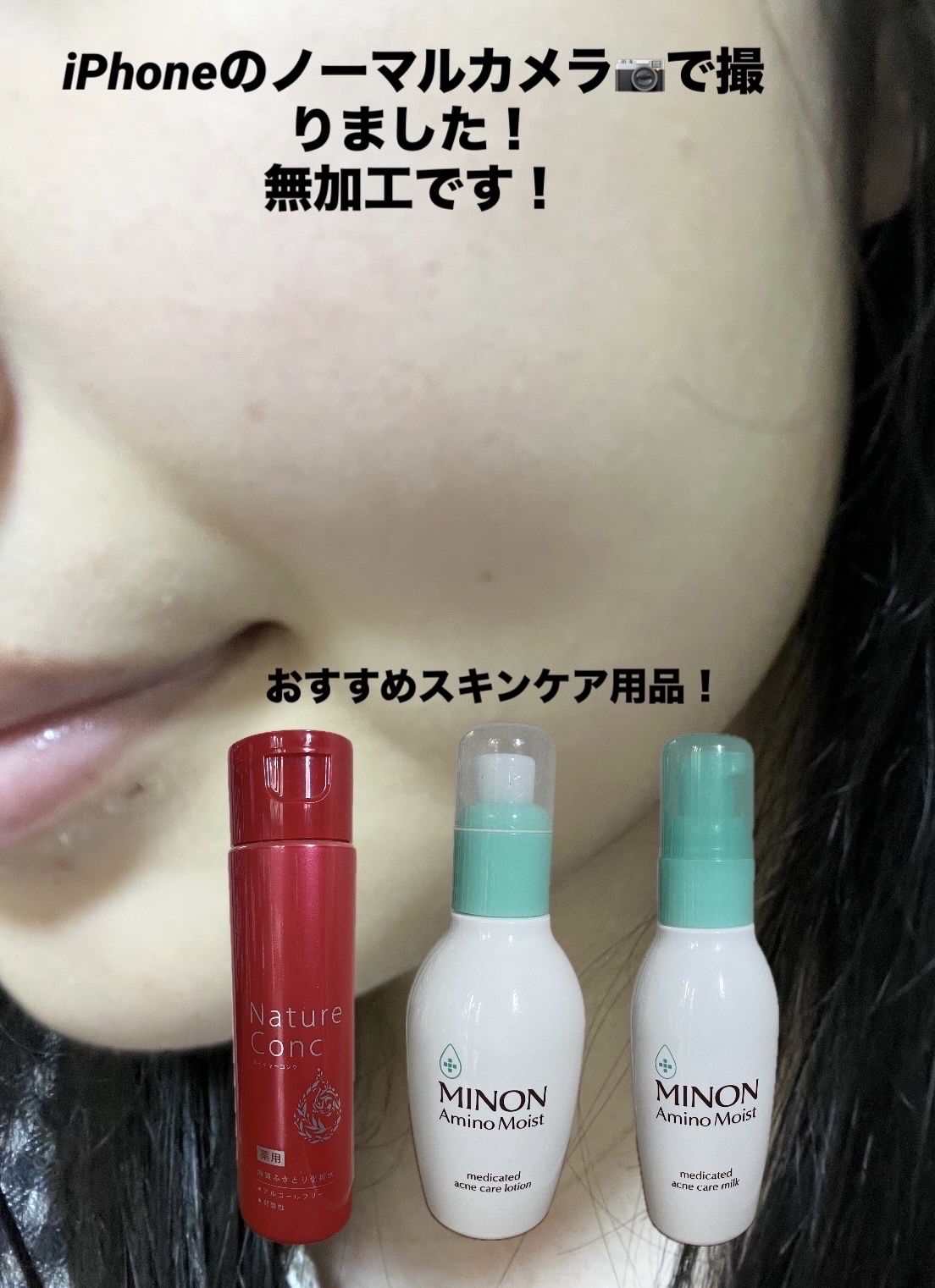 ミノン アミノモイスト 薬用アクネケア ローション/ミノン/化粧水を使ったクチコミ（1枚目）