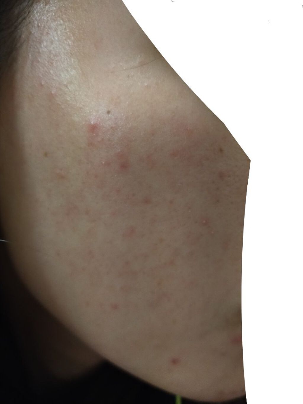 薬用 しみ 集中対策 美容液/メラノCC/美容液を使ったクチコミ（2枚目）