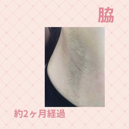 光美容器KE-NON(ケノン)/エムテック/家庭用脱毛器を使ったクチコミ(4枚目)