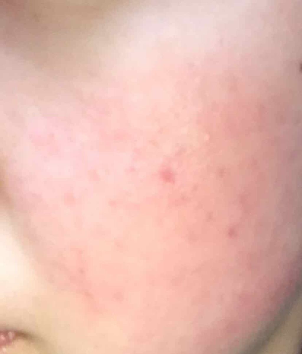 ちょこ on LIPS 「謎の肌荒れから5日経ちました!昨日ものせたんだけどね笑でもでも..」(2枚目)