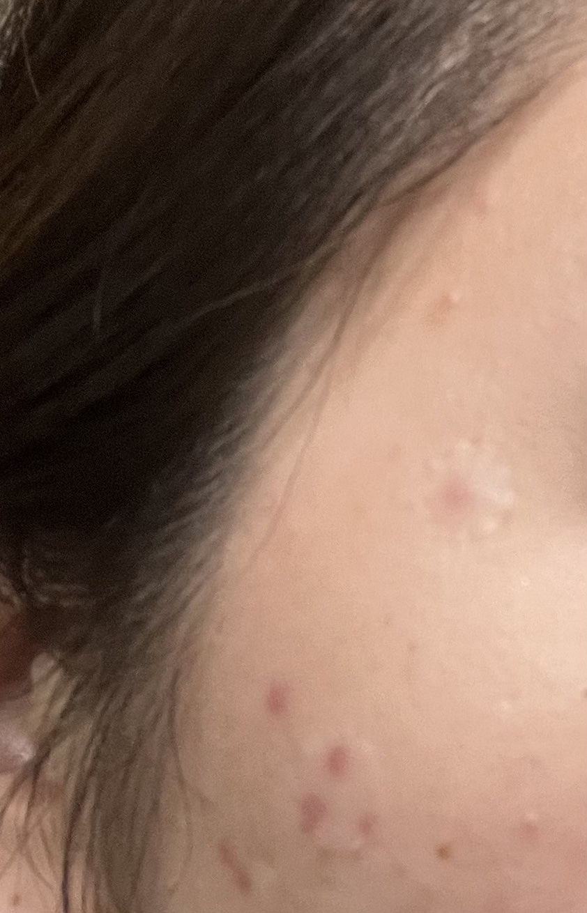 薄型ハイドロコロイドポイントシール/キャンドゥ/その他を使ったクチコミ（3枚目）