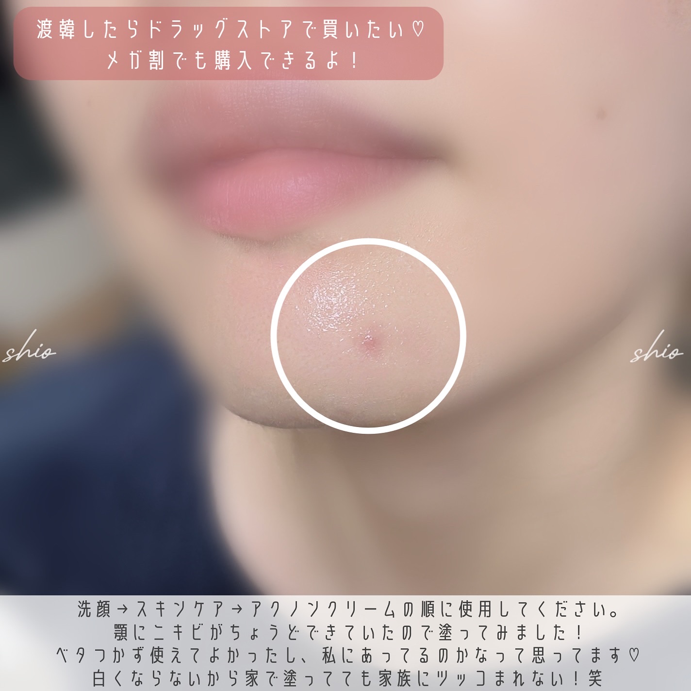 アクノンクリーム/東亜製薬/その他スキンケアを使ったクチコミ（3枚目）