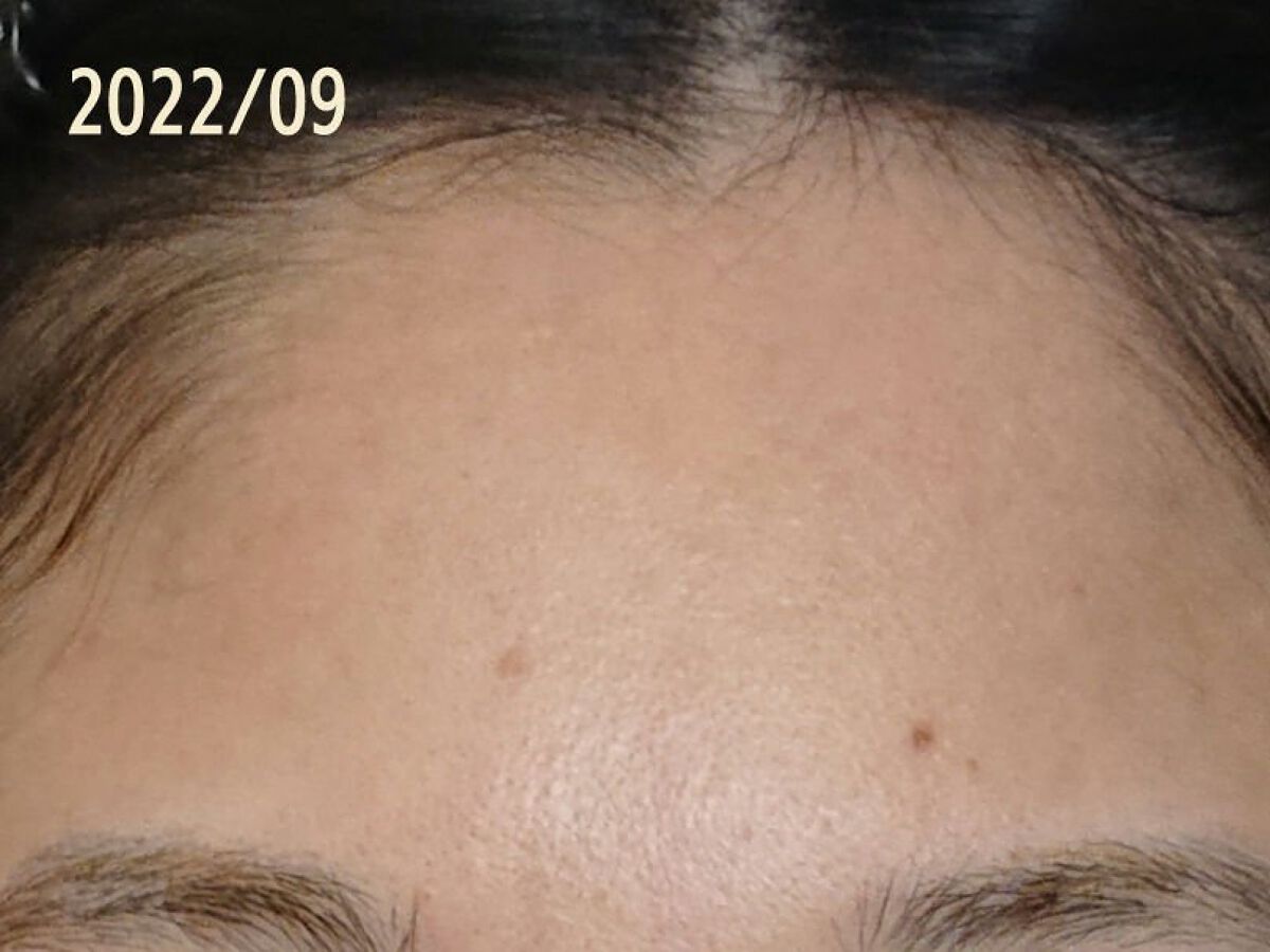 薬用しみ集中対策 プレミアム美容液/メラノCC/美容液を使ったクチコミ（3枚目）