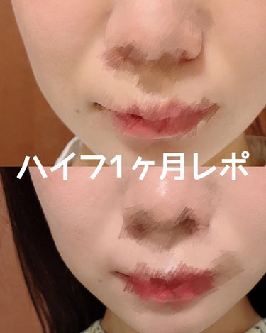 ぴーちゃん🧡 on LIPS 「医療ハイフレポ👩‍⚕️今日はコスメではなく美容医療ハイフについ..」（1枚目）