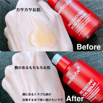 NiCO*フォロバ100 on LIPS 「*medicubuレッドアクネセラムニキビ肌のケア、ニキビ肌に..」(2枚目)