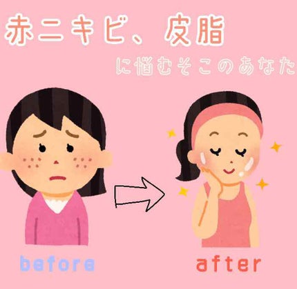 大人のニキビ対策 薬用美白化粧水/肌美精/化粧水を使ったクチコミ(1枚目)