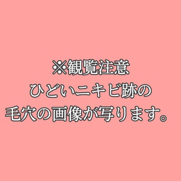 なー on LIPS 「#相談#クレーター#ニキビ跡#悩みクレーターの相談です。本当に..」（1枚目）