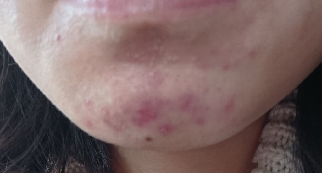 shiny_rouge_4z2 on LIPS 「ニキビ治療から2ヶ月、、やっっとニキビが無くなった!!!!っと..」(2枚目)